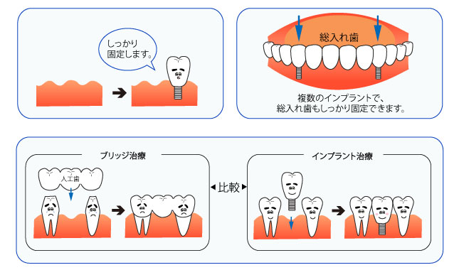 インプラント